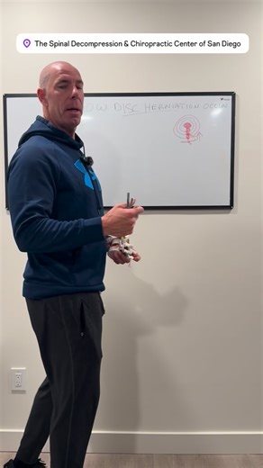 Doctor Boelk on Instagram: "How a Disc Really Herniates (and What You Can Do About It) Ever wonder what’s actually happening when you’re told you have a disc herniation? Your spinal discs have outer rings — like layers of an onion — protecting a soft gel center. Over time, bending, sitting too long, or lifting incorrectly can cause tiny tears in those rings. Eventually, the gel (or “jelly”) pushes out and presses on a nerve. That’s when you feel sharp pain, tingling, or sciatica. At our clinic, 