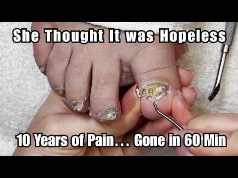 She Thought Her Thick Toenails Were Hopeless… Until This Pedicure