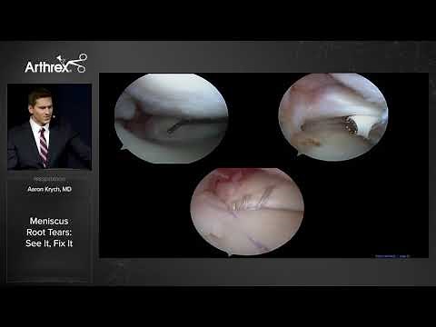 Meniscus Root Tears: See It, Fix It