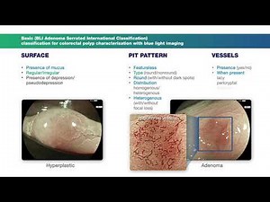Basic Classification Colonic Polyps