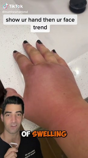 Arm swelling , what is going on | yellow swollen hand