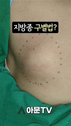 3 Self-Diagnosis Methods to Differentiate a Lipoma (Plastic Surgery Lipoma Lump Cyst Nodule Sebum...