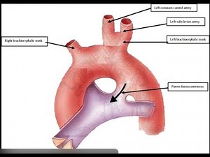 CARDIAC PATHOLOGY : Acyanotic Congenital Heart Diseases USMLE STEP 1 podcast