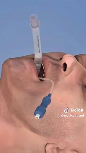 How LMA Insertion Procedure (3D Animation) Laryngeal Mask Airway Insertion is used to keep the airway open during anesthesia. A soft mask-like device is placed through the mouth and positioned over the Larynx. This allows oxygen and anesthetic gases to flow into the lungs. #lma #airwaymanagement #anesthesia #medicalanimation #3danimation