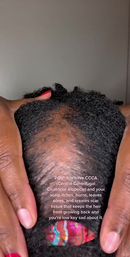 Understanding CCCA Hair Loss: Journey, Treatment, and Tips