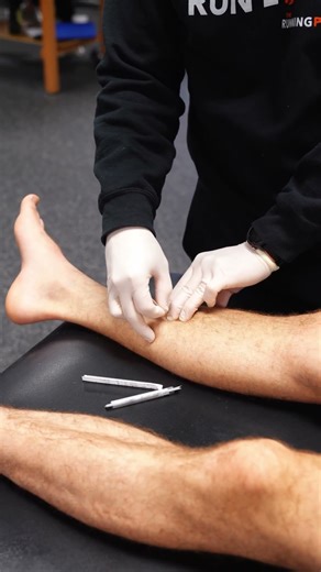 Dry Needling for Shin Splints