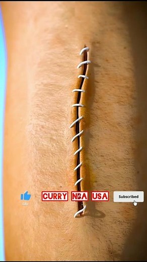 How Stitches Work 😱 | Amazing Medical Science Explained”