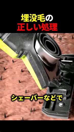 埋没毛の正しい処理の仕方