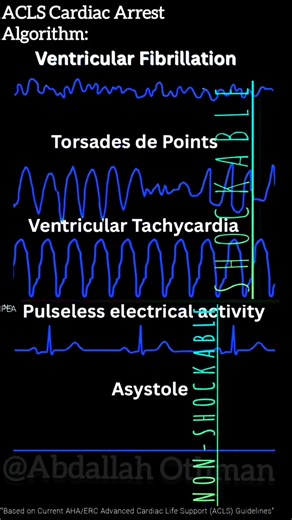 ACLS Cardiac Arrest Algorithm:Shockable vs. Non-Shockable Rhythm Pathway · Shockable: VF/VT. Treat with immediate defibrillation. · Torsades de Pointes is a polymorphic VT. Defibrillate if pulseless. Correct underlying causes (e.g., hypomagnesemia, long QT). · Non-Shockable: PEA/Asystole. Treat with CPR, Epinephrine, and reversible causes (Hs & Ts). Cycle: 2 min CPR → Rhythm Check → Act. #TorsadesDePointes #PolymorphicVT #CardiacArrest #ACLS #ECG #VF #VT #PEA #Asystole #Resuscitation #Cardiology