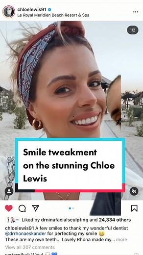 Chloe Lewis: Dental Smile Makeover with Veneers and Bonding