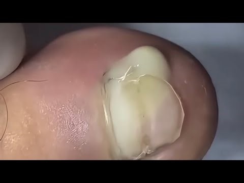 VOCÊ NÃO VAI ACREDITAR NO QUE SAIU DESSA UNHA ENCRAVADA! #satisfying #manicure #nails