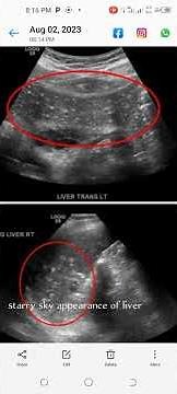 ultrasound signs.....starry sky appearance of liver....