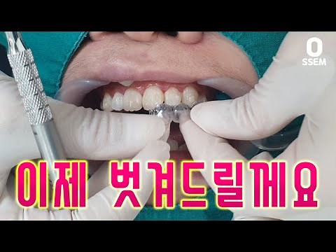 치아교정 시작 인비절라인! 어태치먼트 부착 하는날(투명교정기 붙이기)