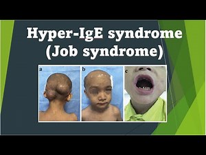 Hyper IgE syndrome (Job Syndrome) - Immunology USMLE Step 1
