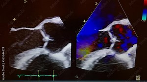 Doppler echocardiogram of aortic valve in action - HD Video