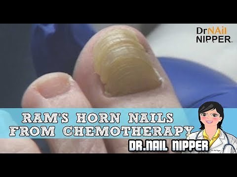 Ram's Horn Nails From Chemotherapy - Dr Nail Nipper