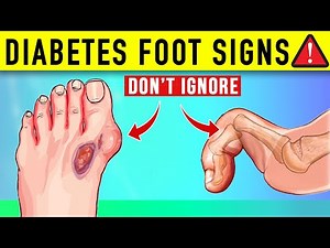 10 Must Know Signs Your Feet Tell You About Diabetes!