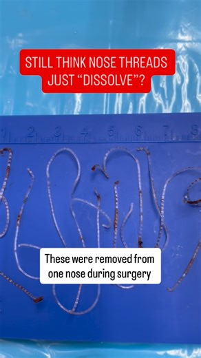 Assoc Prof Dr Eugene Wong on Instagram: "Still think nose threads just “dissolve”? These were removed from one nose during surgery. Thread-lift rhinoplasty may look simple on the surface, but the threads — especially the barbed types — can create problems beneath the skin. Those tiny hooks are designed to anchor into the soft tissue, and the body forms scar tissue around them. This can lead to: • asymmetric fibrosis, which can pull the soft tissue off-centre • tethering from scar tissue, reducin