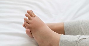 Anasarque : causes, symptômes et traitement de ce syndrome œdémateux généralisé
