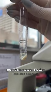 115K views · 829 reactions | Microscopic examination of the peritoneal fluid from a 64-year-old female patient. What do you see? #microscopy #bacteriology #microscopicexamination #microbiology #microscope #microbiologist @topfans #foryoupage #explorepage #science #fyp #lab #reels #memes #biochemistry #sciencememes #bacteria | Microbiologists | Facebook