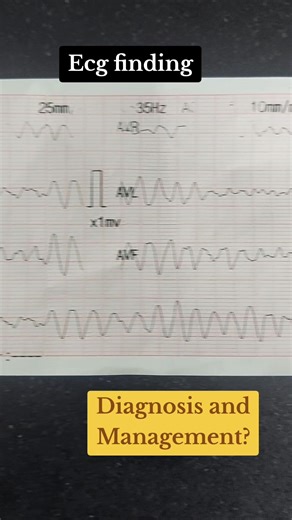 Ecg quiz 18! Findings, diagnosis and management? #ecg #ekg #cardio #cardiology #medicina #doctor #doctorsoftiktok #doctora #doctores #kardiologie #medicalstudent #medicine #medstudent #ecginterpretation #heartattack #vfib #usa