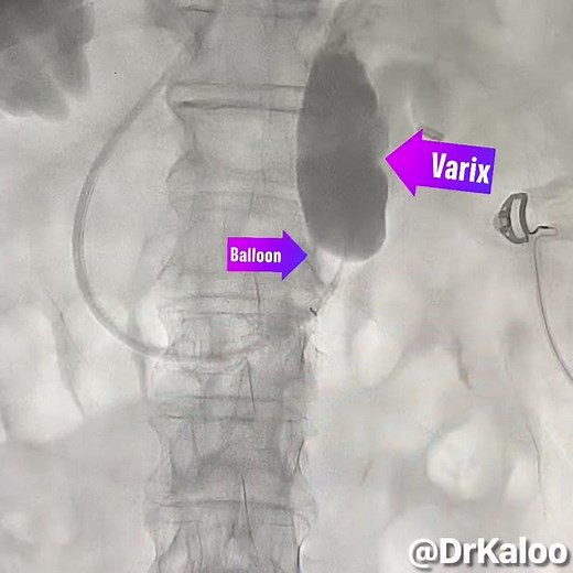 BRTO (Balloon Retrograde Transvenous Obliteration of Shunt)