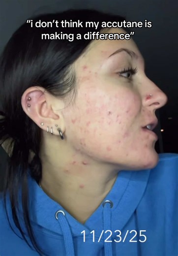 my biggest regret is not taking it sooner. but i will say the stress from grief does not help… #accutane #accutanejourney #acne #acnetreatment