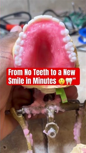 From No Teeth to a New Smile in Minutes 😲🦷”#dentist #teethdecay #dentures #shortvideo #dentalcare
