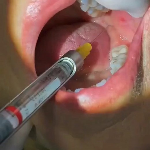 All Dental / Вся Стоматология on Instagram: "A short #dental #tutorial showing @nelliemanoukian the angulation of the IA block (nervus alveolaris inferior) and how to bypass the lingula (the small bone lip in front of the mandibular foramen). Also mentioned how a long needle bypassing the whole mandible can end up beyond the distal end of the jawbone and numb the facial nerve in the parotid gland area causing Bell’s palsy paralysis. Our patient was very nice to allow us to use her actual numbing