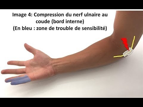 Nerf cubitale (ulnaire) soulagez sa compression naturellement