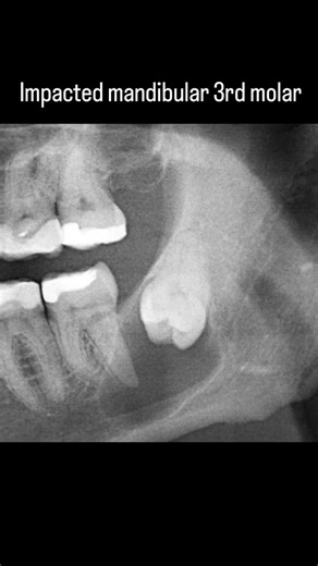 impaction #dentist #impaction #dentistry #dentessa#viral #ytshorts