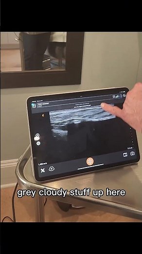 Dr. Shenker Shows Ultrasound for Breast Implant Check Ups