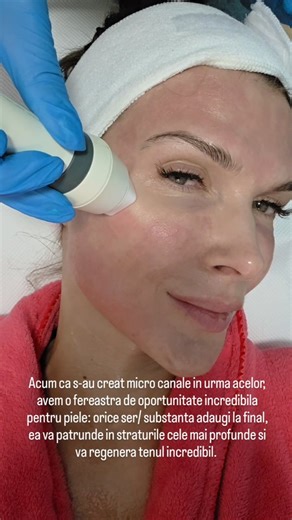 monica gheorghita-birladeanu on Instagram: "Micro-needling cu radiofrecvență inainte de vacanta de Craciun💥💥❤️ 3 lucruri esențiale: - stimulează profund colagenul și elastina, cu efect vizibil de lifting - creează o mare oporrunitate pentru activele performante (exozomi, peptide) sa patrunda profund - îmbunătățește real si vizibil textura, tonusul și fermitatea pielii Si inca ceva: stiu ca se spune "volumizare" acestei proceduri, dar sincer pielea mea dupa microneedling pare mai ferma, mai str