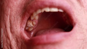 Close up man open mouth, jaw with teeth, detailed sealed tooth after surgery in dental clinic office. Tooth extraction treatment. Caries removing, nerve removal canals. Wisdom tooth Stock Video