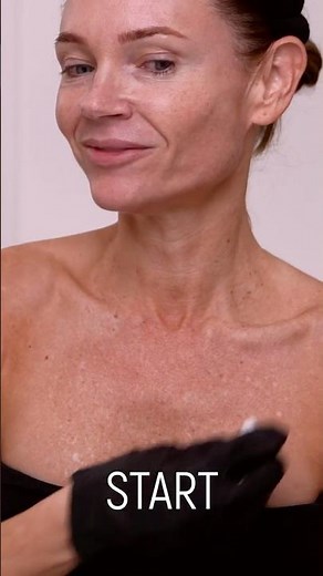 Applying the First Layer of My 20% TCA Neck & Chest Peel ⏱️ | 5-Minute Timer Starts Now