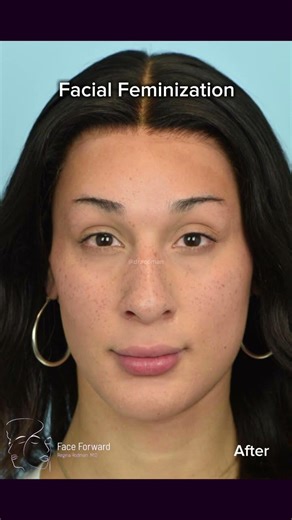 Facial Feminization| Before and After| Facial Plastic Surgery