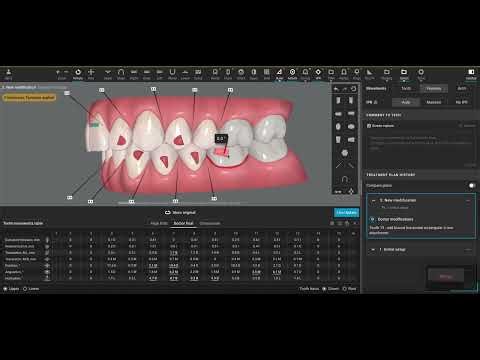 Invisalign Clincheck - Level Curve of Spee