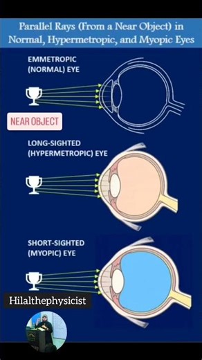 How Normal , Hypermetropic ,Myopic Eye Focus Far & Near objects #science #infoknow #students #facts