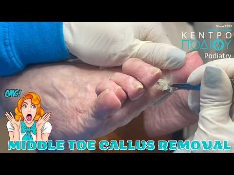 Middle toe callus removal|Μεσοδακτύλιος Κάλος #kentropodiou #κεντροποδιου #podology #podiatrist