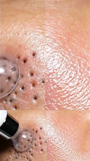 Before and after macro split showing congested pores versus freshly vacuumed skin ASMR