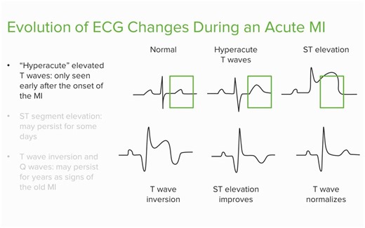 Myocardial Infarction (MI): STEMI vs NSTEMI – Med-Surg Nursing