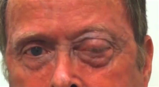 6.3K views · 43 reactions | Valsalva induced ptosis and proptosis- due to rise in intrathoracic pressure and CVP-> intraocular pressure-> rupture of capillaries resulting in non traumatic ocular hemorrhage. Rx- anti-edema,anti inflammatory,anti-glaucoma. Surgical drainage needed in optic nerve compression. | Cardiophilia | Facebook