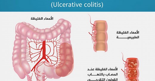 ألم المستقيم.. الأسباب والعلاج