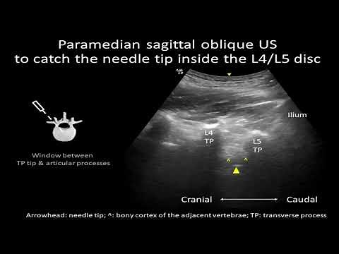 US-guided lumbar intradiscal injection for discogenic pain - Supplementary video 2 [ID 253047]