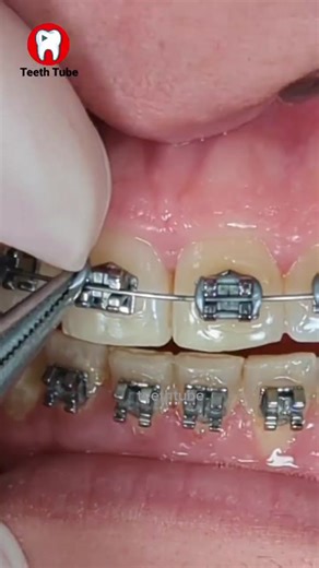 Grey Braces: Colorful Options for Orthodontic Treatment