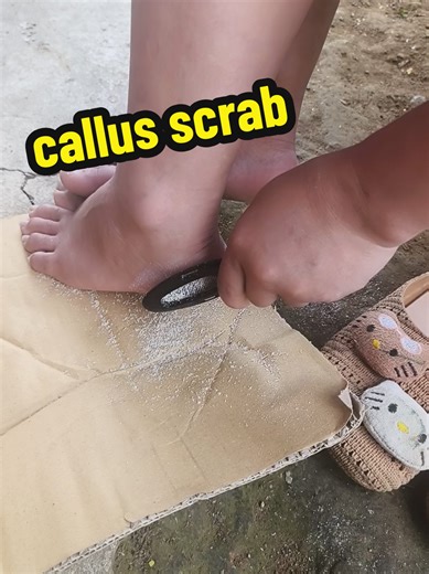 Effective Callus Treatment Techniques