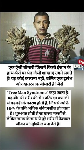 Tree Man बीमारी क्या है? | जब इंसान के हाथ बन जाते हैं पेड़ की शाखाएं 🌳🧬 #tree #disease #yt #shorts