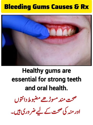 Effective Treatment for Bleeding Gums