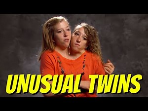 Top 5 Siamese Twins You Won't Believe Exist - Unusual Conjoined Twin Children - Wow Wow