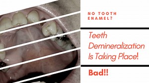 Best Remineralizing Tooth Powder: Natural & Safe Options - Mouth Ninja